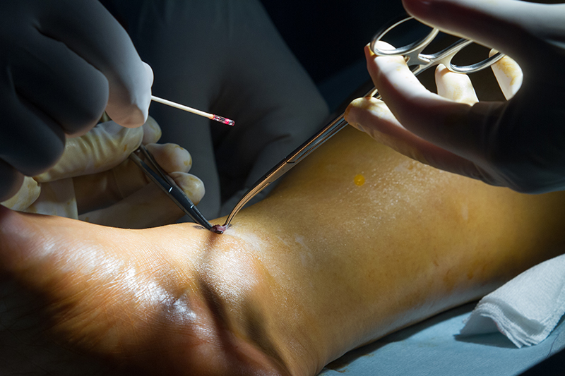 operatie chirurgicala varice gel de racire pentru picioare în varicoza